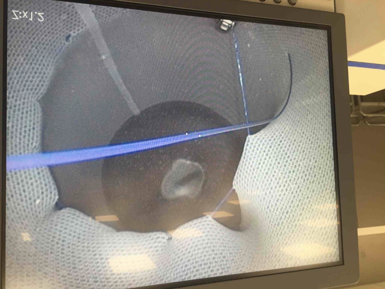 Gap between stitches and therefore suboptimal sealing of the lumen